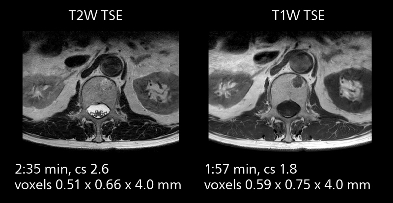 Lumbar spine mri three