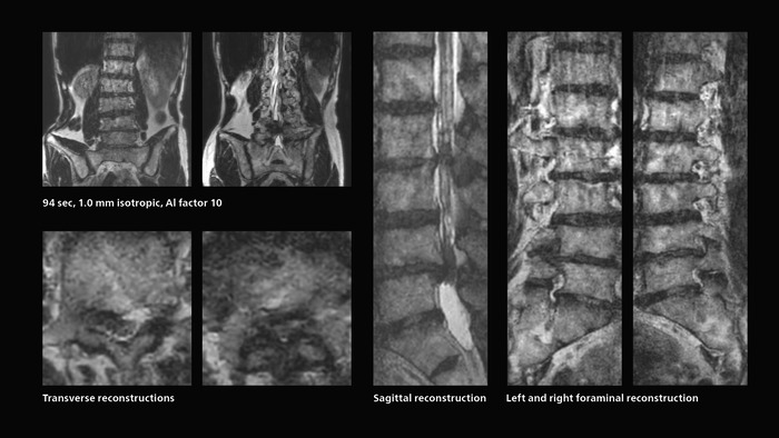 Fast lumbar spine MRI with SmartSpeed of a patient in pain produced a successful isotropic diagnostic scan in only 94 minutes.