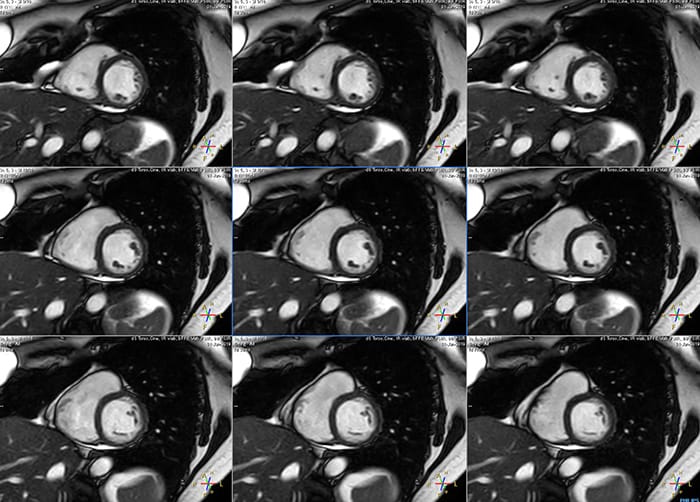 MCVI Ambition Short breath hold cardiac cine