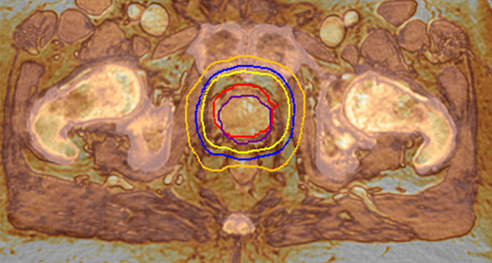 MRI for RT planning